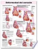 Enfermedad Del Corazon /heart Disease Anatomical Chart